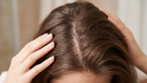 Scalp condition affecting hair growth